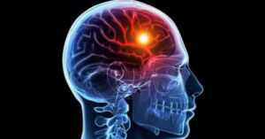 Read more about the article ما هي أعراض الجلطة