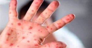 Read more about the article أعراض خطِرة لجدري القرود