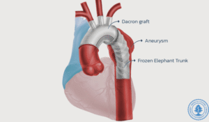 Read more about the article الجامعة الأميركية: المركز الطبي أنجز أول جراحة “Frozen Elephant Trunk” في لبنان