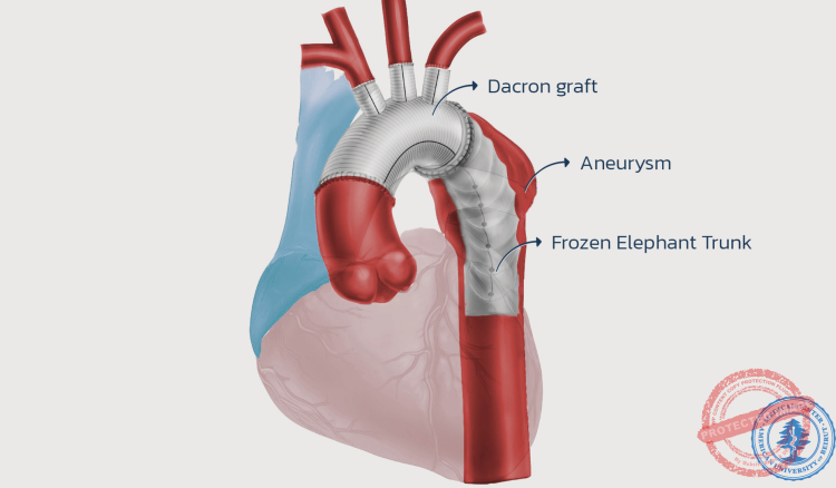 Read more about the article الجامعة الأميركية: المركز الطبي أنجز أول جراحة “Frozen Elephant Trunk” في لبنان